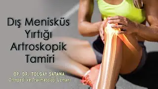 Dış Menisküs Yırtığı Artroskopik Tamiri