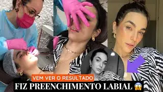 PROJETO NOIVA: FIZ PREENCHIMENTO LABIAL 😱