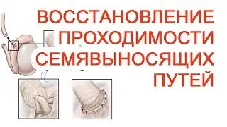Восстановление проходимости семявыносящих протоков / Доктор Черепанов