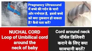 अल्ट्रासाउंड में बेबी के गले मे अगर नाल हैं तो नॉर्मल डिलिवरी होगी या सिजेरियन जरुरी है NUCHAL CORD