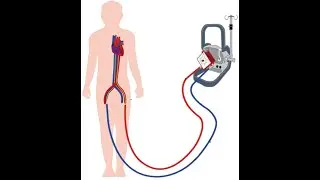 Differential Hypoxemia VA ECMO_Dr Pradeep Rangappa