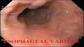 Portal hypertension with esophageal varices| Cirrhosis of liver| Esophageal banding| Dr. Pandiaraja