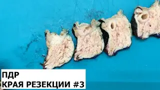 Панкреато-дуоденальная резекция. Края резекции. Часть 3.