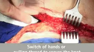 Abdominal Wall Closure BBraun®