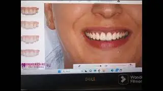 Smile Design