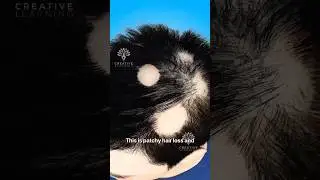 Why Am I Losing Hair in Patches - Explain Alopecia Areata 
