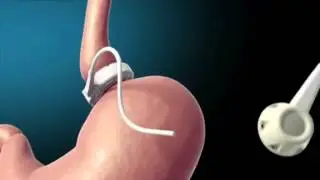 Adjustable Gastric Banding Animation