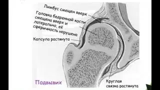 Дисплазия у детей.қазақша дисплазия