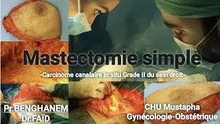 Simple Mastectomy / Mastectomie simple -carcinome canalaire in situ Grade II-
