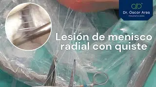 Lesión de menisco radial con quiste - Dr. Oscar Ares