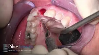 Pedicle CTG with Nasopalatine Addressed