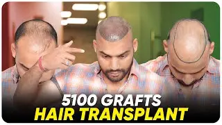 Hair Transplant in Hyderabad | Best Results & Cost of Hair Transplant in Hyderabad