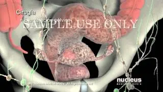 Tratamientos para el cáncer de cuello uterino