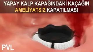 PVL KAPATMA | Paravalvüler Kaçak Nasıl Kapatılır?