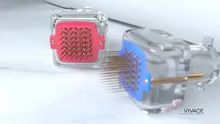 The Vivace Experience   Microneedling with Omni Centers