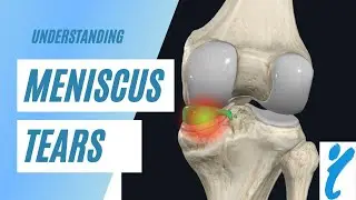 What is a Meniscus Tear?