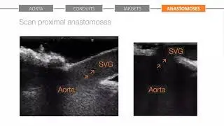 REQUEST Workflow Step 4 - Anastomoses