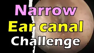 EARWAX removal (Narrow Ear Canal)