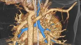 Pediatrik Aort Ark