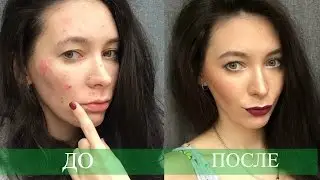 Уход за кожей!Моя УЖАСНАЯ История!!!Как избавиться от прыщей?!