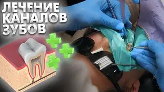 Эндодонтическое лечение каналов зуба с разветвленными каналами