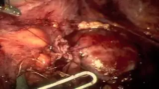 Robotic assisted Laprascopic Left Pyeloplasty