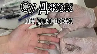 Су Джок не для Всех. Акупунктура