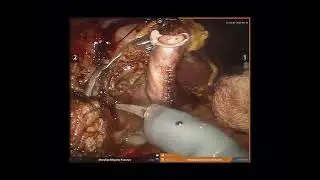 GASTRODUODENOPANCREATECTOMIA ROBÓTICA - GDP NO TRATAMENTO DE CÂNCER DE PÂNCREAS