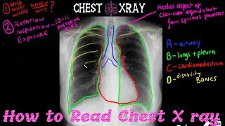 How to Read Chest X ray | Medical Technology
