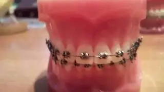 Брекет-система Smart-Clip
