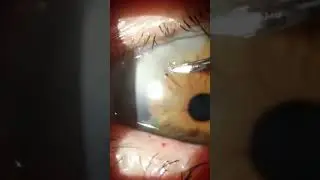 Corneal Foreign Body Removal 