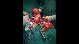DESARTERIALIZACION UTERINA MIOMECTOMIA * TECNICA DE POSADAS *