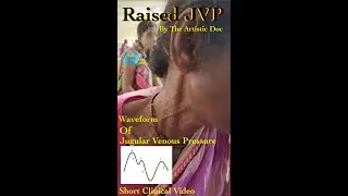 Raised Jugular Venous Pressure |Short Clinical Video | Wave components | Causes of Abnormalities