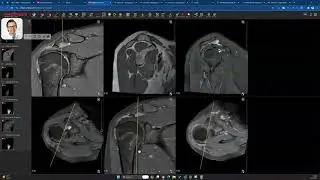 How to Spot Lipoma Aborescens (Shoulder MRI)