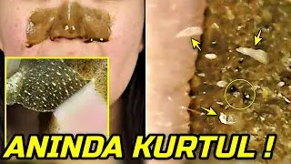 SİYAH NOKTA TEMİZLEME MASKESİ 