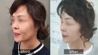 Nose Lifting | Nose Thread Lift | Nose Thread Lift with WPDO Threads | #shorts | #ShortsVideo |