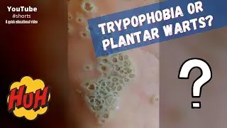 Trypophobia or plantar warts? 