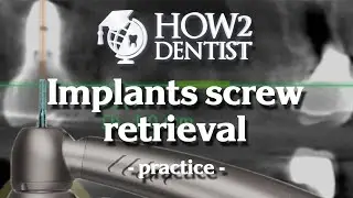 How to change cement fixation to screw / How to Dentist