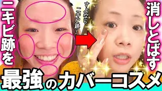 【さよならニキビ跡】圧倒的カバー力でニキビ跡が消滅✨元美容部員イチオシの最強カバーコスメランキング!!【ベストコスメ2019】