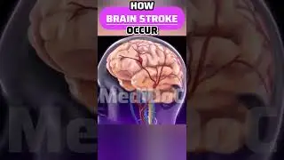 How BRAIN STROKE Occur 3D Animation #brainstroke