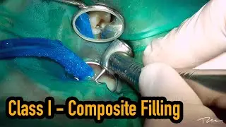 Tooth colored filling - Class I composite restoration