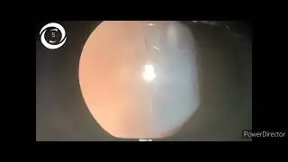 Ophthalmic Signs 493