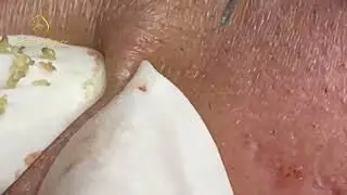 Clear Skin Secrets How to Get Rid of Blackheads