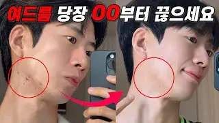 광고❌ 여드름 지금 당장 이것부터 끊으세요❗한달만에 여드름 박멸한 방법