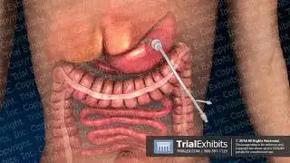 Small Bowel Obstruction with Resulting Displacement of PEG Tube