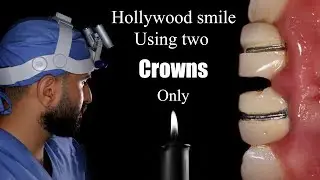 Hollywood smile using zirconia to replace two metallic old crowns