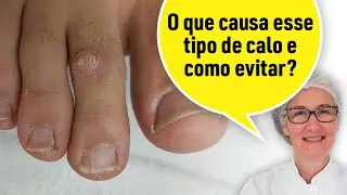 CALO EM CIMA DO DEDO