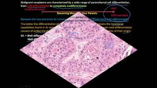 113P How to tell a benign and malignant tumor apart? Differentiation and Anaplasia