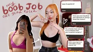 GETTING A BOOB JOB @ 20 yrs old.. one year post-op & answering your questions
