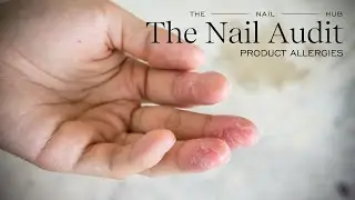 The Truth About Nail Product Allergies: Why Your Gel Is Causing Rashes, Redness & Peeling